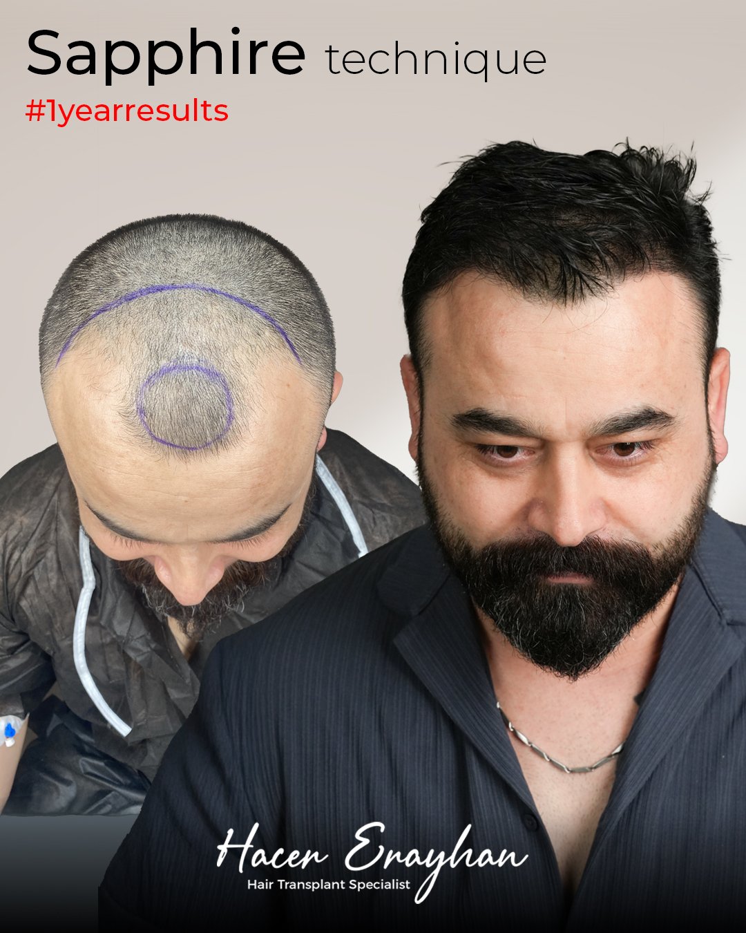 Öncesi Sonrası Sonuç 11